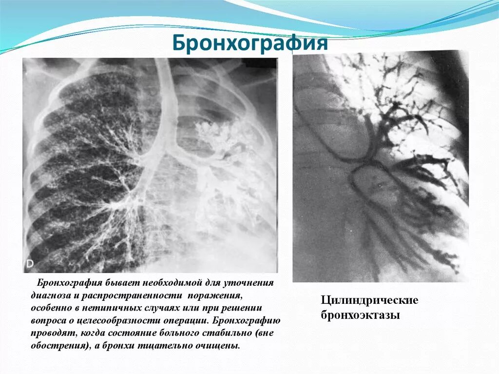 Бронхит бронхоэктатическая болезнь. Бронхоэктазы рентген бронхография. Бронхография патология. Хронический бронхит бронхография.