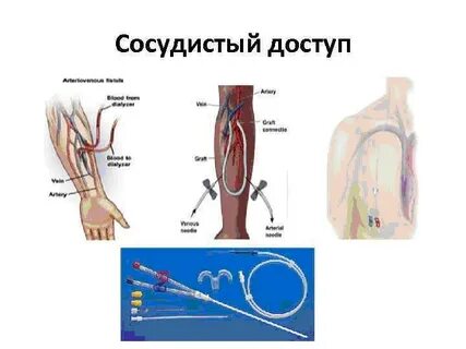 Фистула для гемодиализа