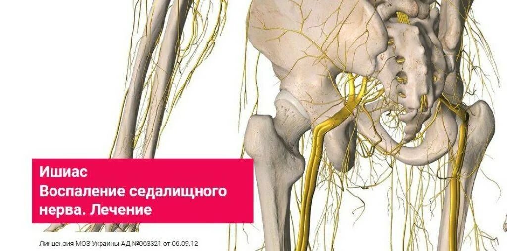 Как вылечить защемление седалищного нерва. Защемление седалищного нерва s1. седалищный нерв кармацких. невропатия седалищного нерва.