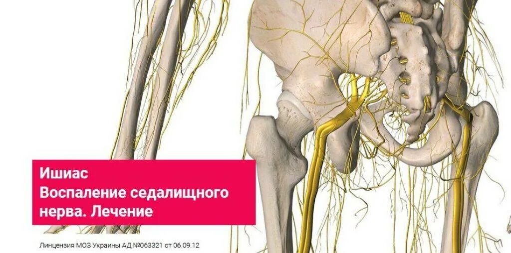 Воспаление седалищного нерва симптомы у мужчин. Защемление седалищного нерва s1. Седалищный нерв Кармацких. Невропатия седалищного нерва.