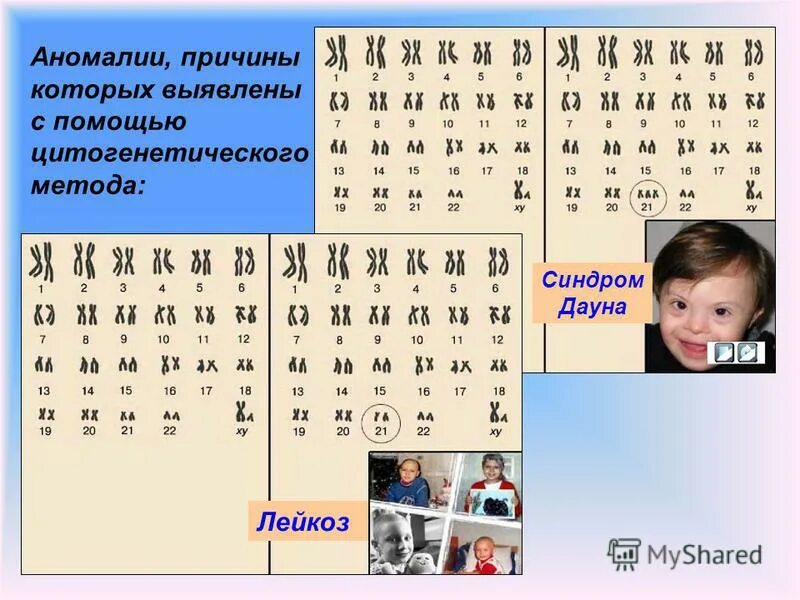 Цитогенетический метод дауна. Синдром дауна исследования. Синдром дауна цитогенетический. Диагности с синдромом дауна. Синдром дауна цитогенетический.