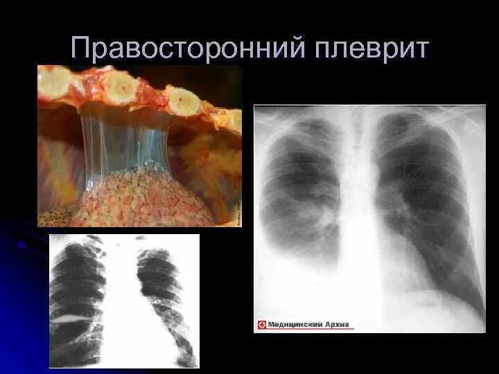 Метастазы в легких что это