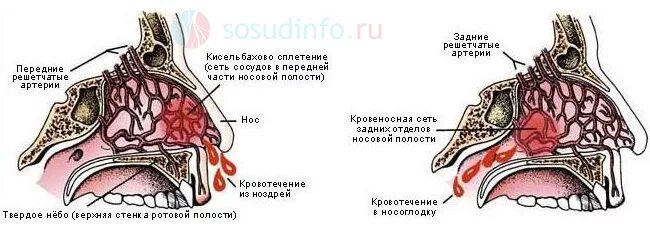 Переднее и заднее носовое кровотечение. Причины носового кровотечения.