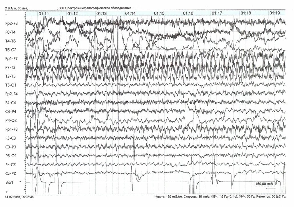 Ээг красноярск. Фотостимуляция ЭЭГ. Генерализованная эпилептиформная активность на ЭЭГ У ребенка. Эпилепсия на ЭЭГ. Трехфазные волны на ЭЭГ.