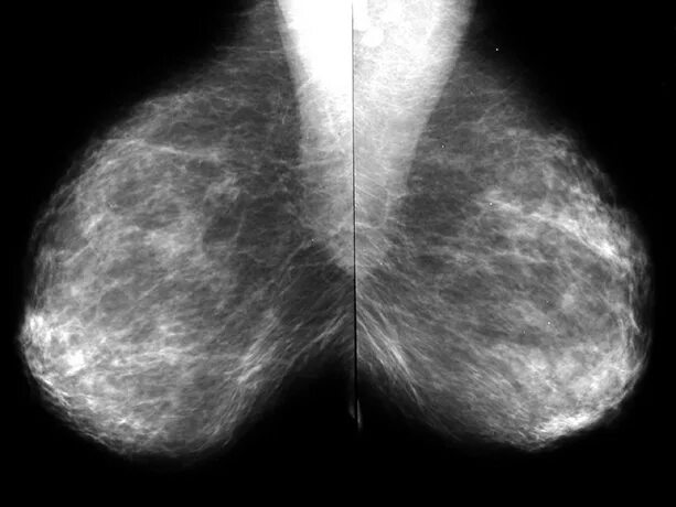 Как на маммографии выглядит рак молочной железы All about Conventional mammography Moose and Doc