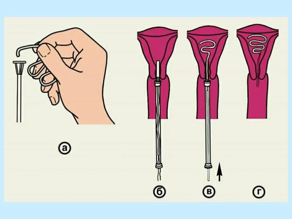 спираль мирена внутриматочная. внутриматочная спираль как устанавливается фото. спираль без месячных. спираль для девушек. извлечение внутриматочной спирали.