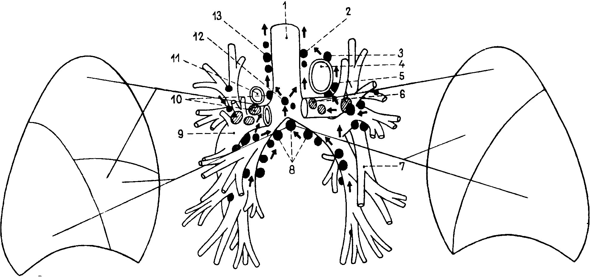 Схема лимфатических узлов легких. Лимфатические узлы средостения схема. Схема лимфоузлов средостения. Внутригрудные лимфатические узлы схема. Лимфоузел в легком причина