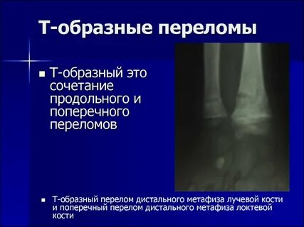 Тест перелом дистального конца