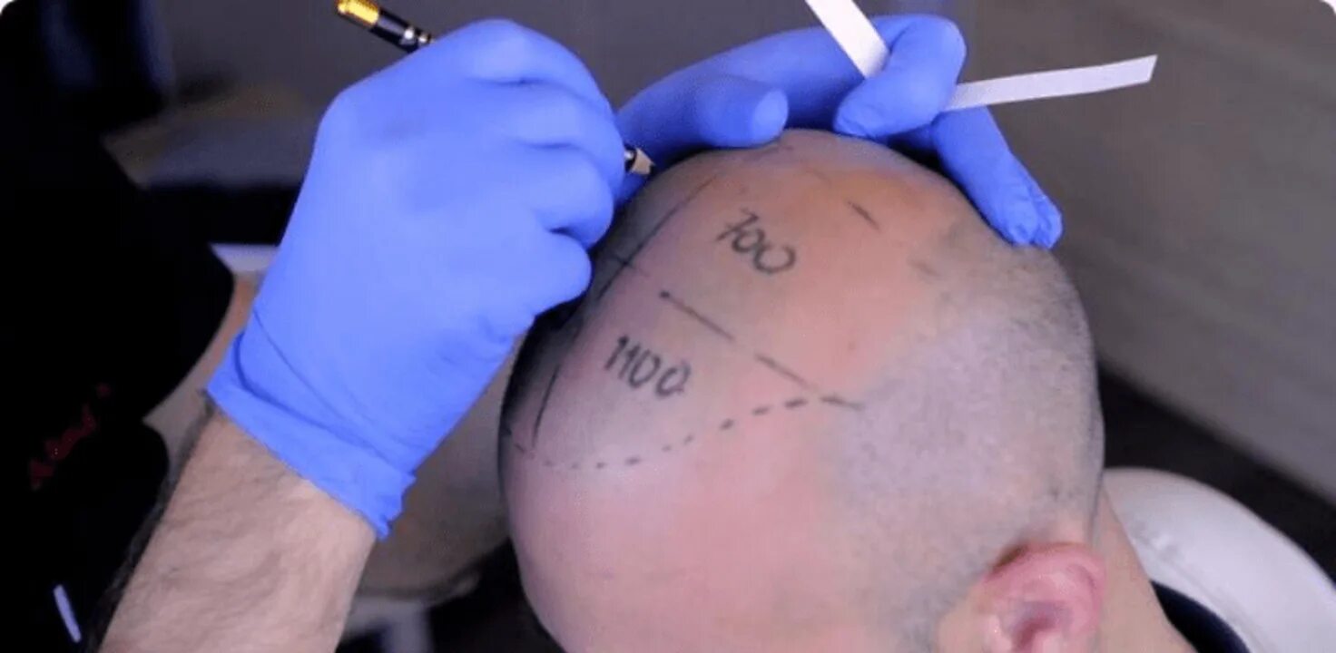 Пересадка 5 часов. Пересадка 5 часов. Графт трансплантация волос. Трансплантация волос до и после. Пересадка 5 часов.
