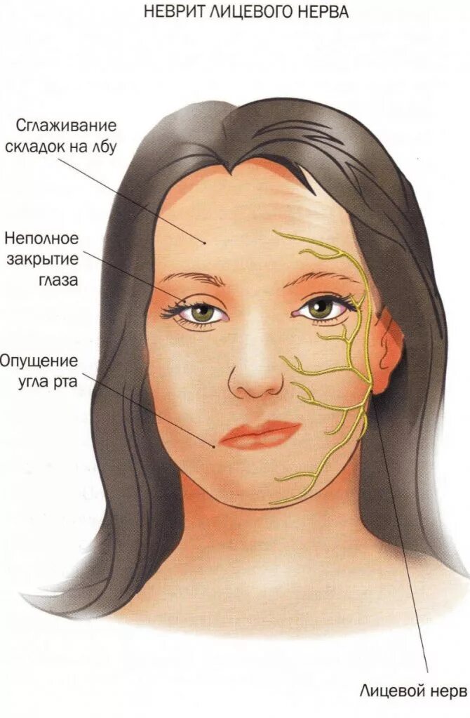 Почему на лбу вены. Неврит лицевого нерва. Неврит тройничного нерва. Воспаление тройничного лицевого нерва. Неврит лицевого нерва и тройничного нерва.