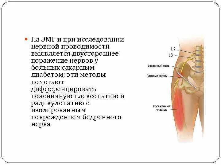 Невропатия кожного нерва бедра. Нейропатия подкожного бедренного нерва. Нейропатия подкожного нерва бедра. Нейропатия латерального нерва бедра.