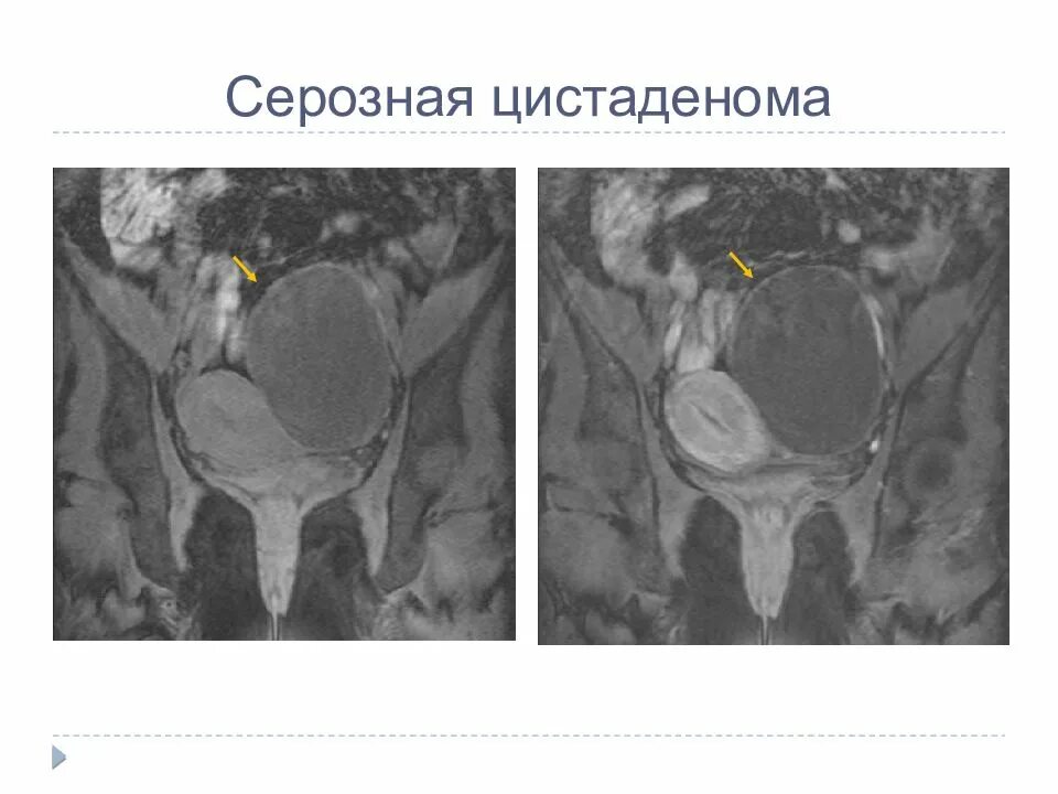 Папиллярная серозная цистаденома. Цистаденокарцинома яичника мрт. Серозная цистаденокарцинома яичника мрт. Серозная цистаденома мрт. Серозная пограничная опухоль