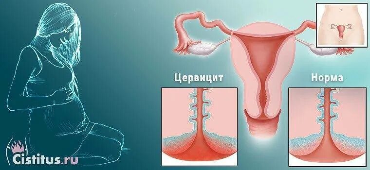 Эндоцервицит шейки матки. Цервицит и эндоцервицит.