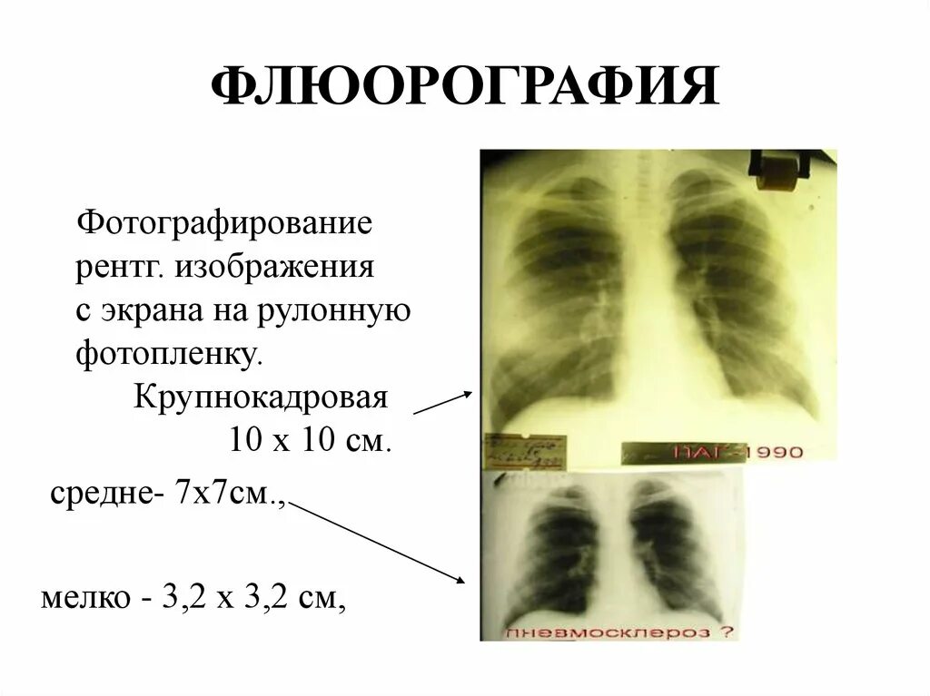 После флюорография можно можно кт делать. Флюорография. Крупнокадровая флюорография. Флюорография легких результат. Флюорография легких норма.