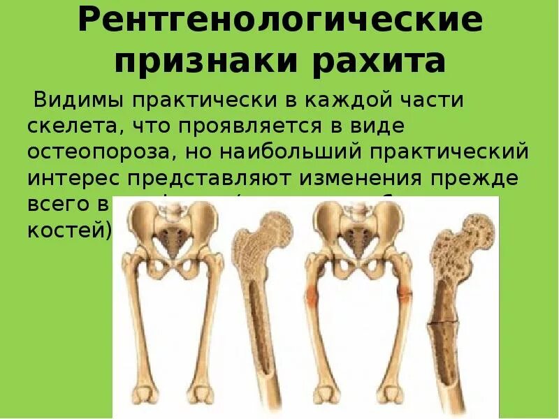 Признаком возрастных изменений костей является. Рахит изменения костей. Изменения в костях при рахите. Рахит изменения костей скелета.