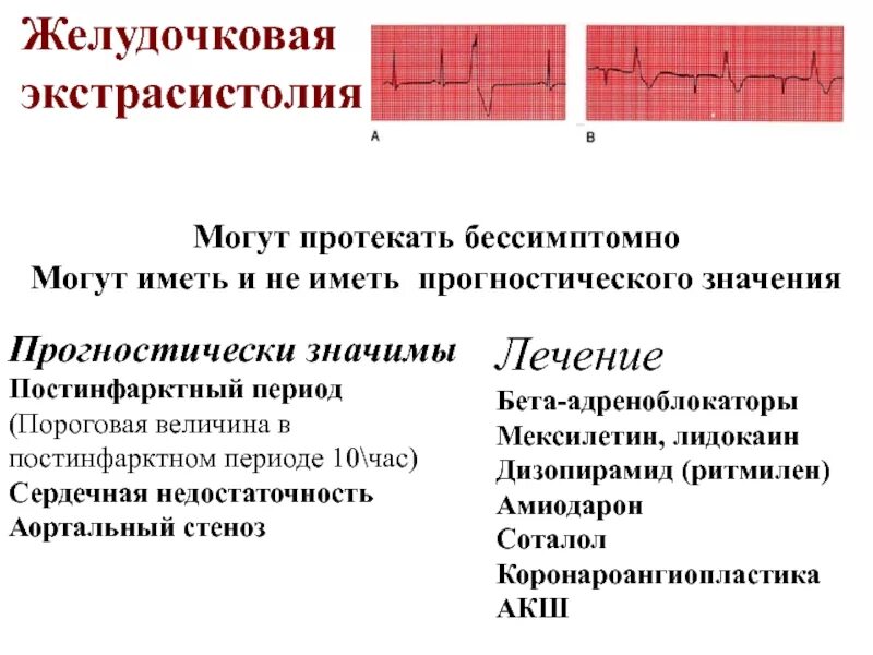 Экстрасистолия сердца симптомы и лечение у взрослых. Желудочковая экстрасистолия причины. желудочковые экстрасистолы. желудочковая экстрасистолия причины возникновения. желудочковая экстрасистолия клинические проявления.