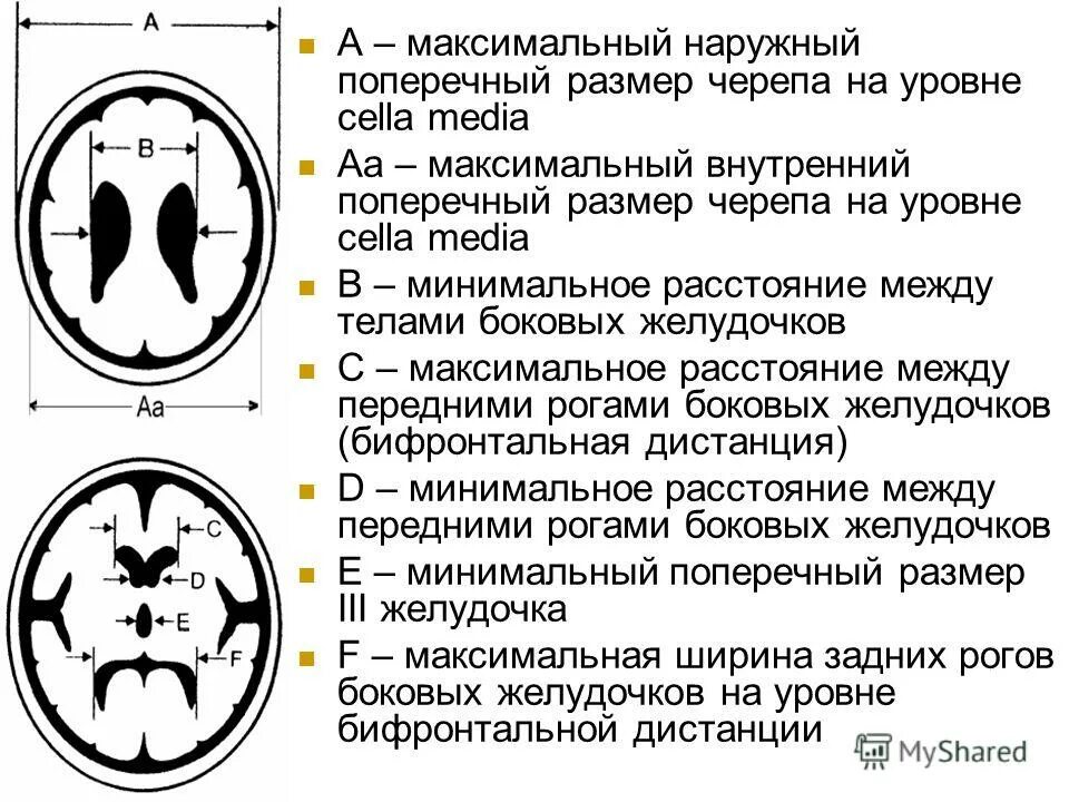 Боковые рога желудочков норма