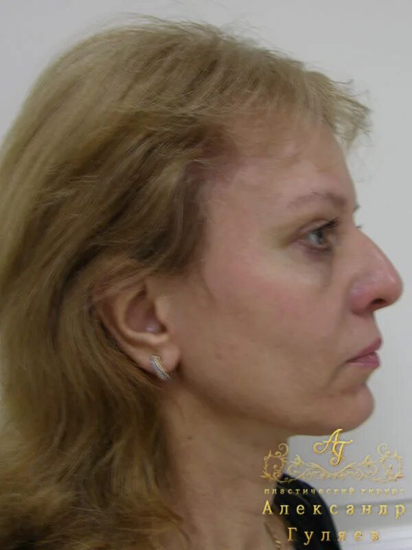 эндоскопический лифтинг средней зоны лица. эндоскопическая подтяжка верхней трети лица. эндоскопическая подтяжка средней трети лица. эндоскопическая подтяжка средней зоны. эндоскопическая подтяжка верхней трети лица.