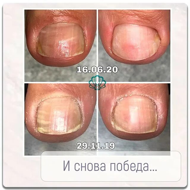 Порубова подолог. Аппаратный педикюр. Порубова подолог. Комбинированный педикюр. Подология медицинский педикюр.