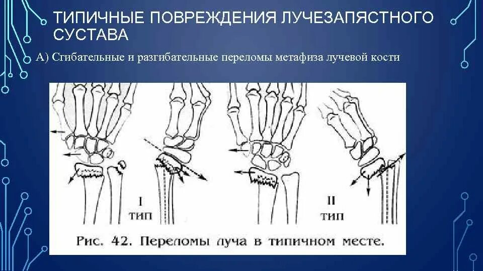 Ушиб лучезапястного сустава код. Разрыв радиоульнарного сочленения лучезапястного сустава. капсульно связочный аппарат лучезапястного сустава. сгибательные и разгибательные переломы метафиза лучевой кости. радиоульнарный угол лучезапястного сустава.