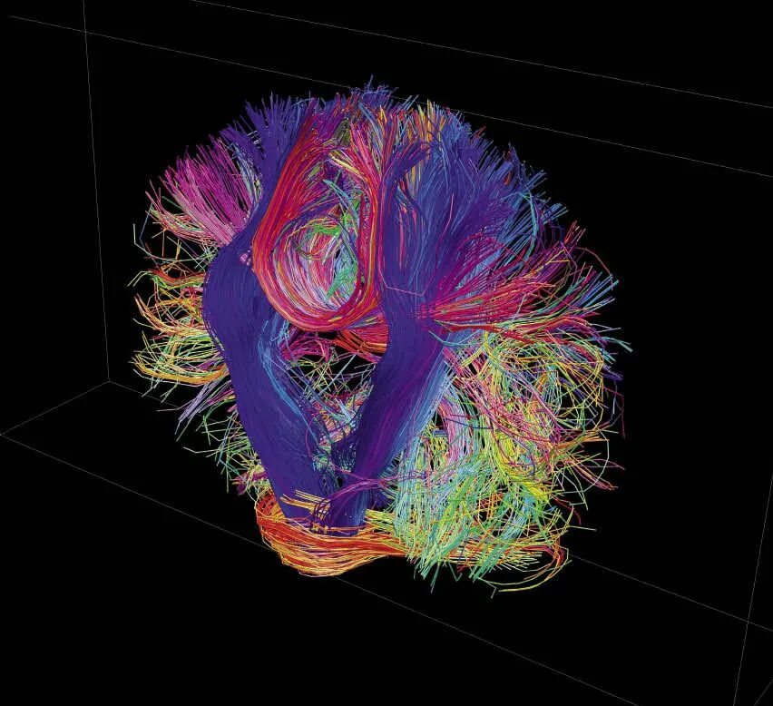 Brain h. Дитфузно тензорная мрт. Трактография спинного мозга мрт. Диффузионно-тензорная томография. Диффузионная тензорная мрт.