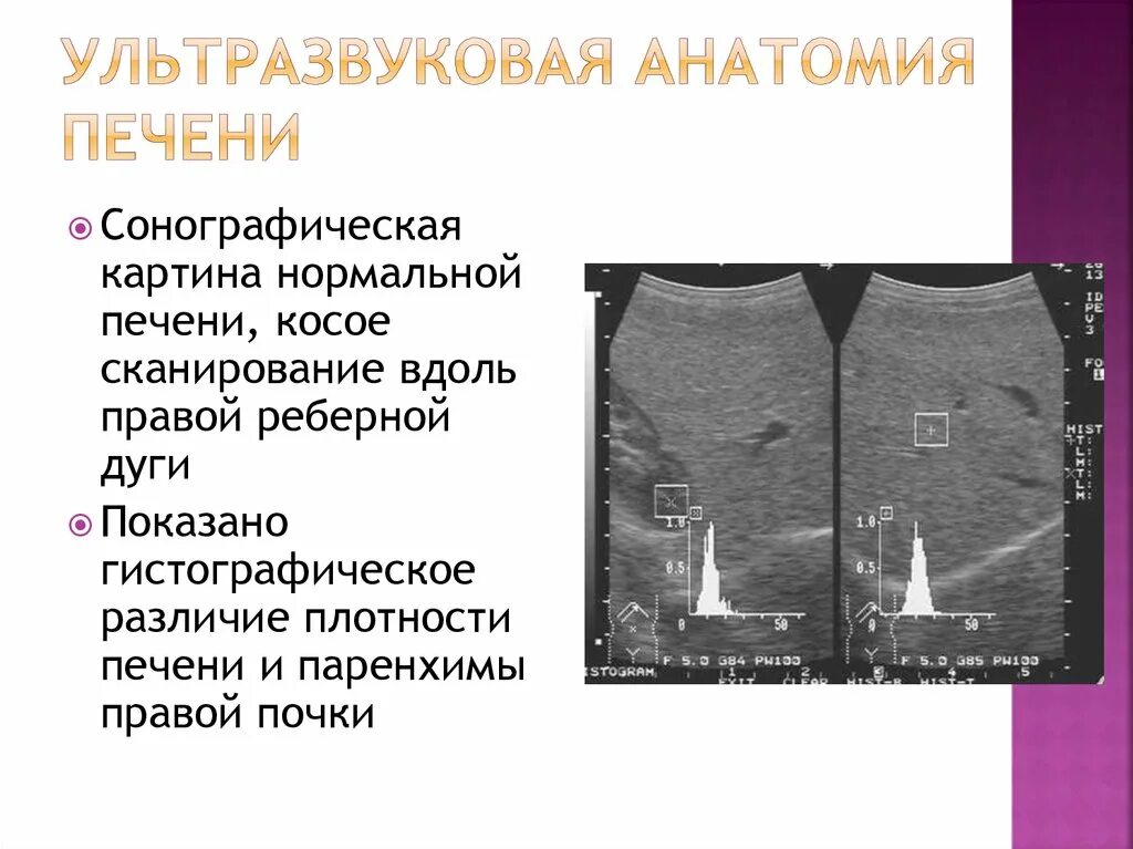 Ультразвуковая анатомия. Плотность печени. Снижение плотности печени. Ультразвуковая анатомия печени. Кт норма печень