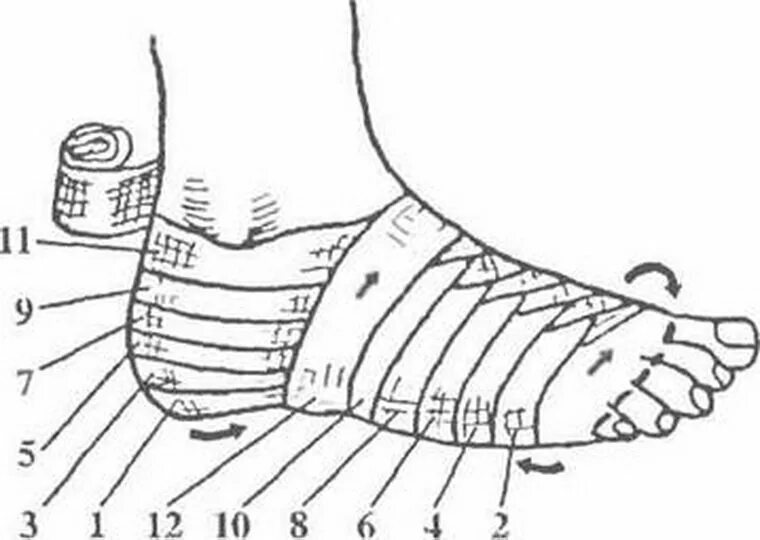 Какая повязка при повреждении голеностопного сустава. Колосовидная повязка на голеностопный сустав. Колосовидная повязка стопы босоножка. Колосовидная повязка на стопу алгоритм. Колосовидная восходящая повязка на стопу.