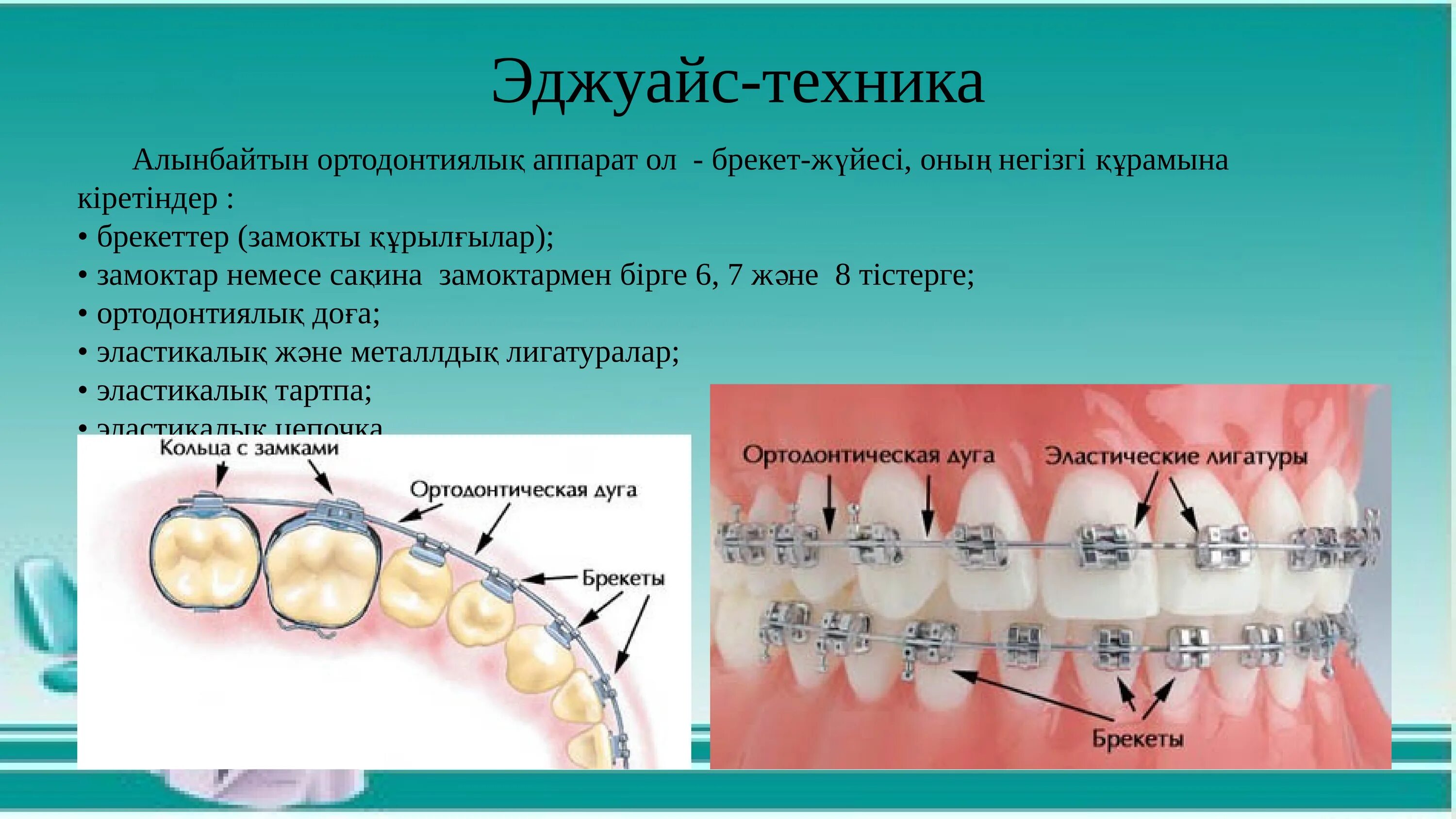 Изгиб зубов. Несъемная техника эджуайс. Эджуайс техника ортодонтия. Эджуайз-техника (брекет-система). Строение брекетов.