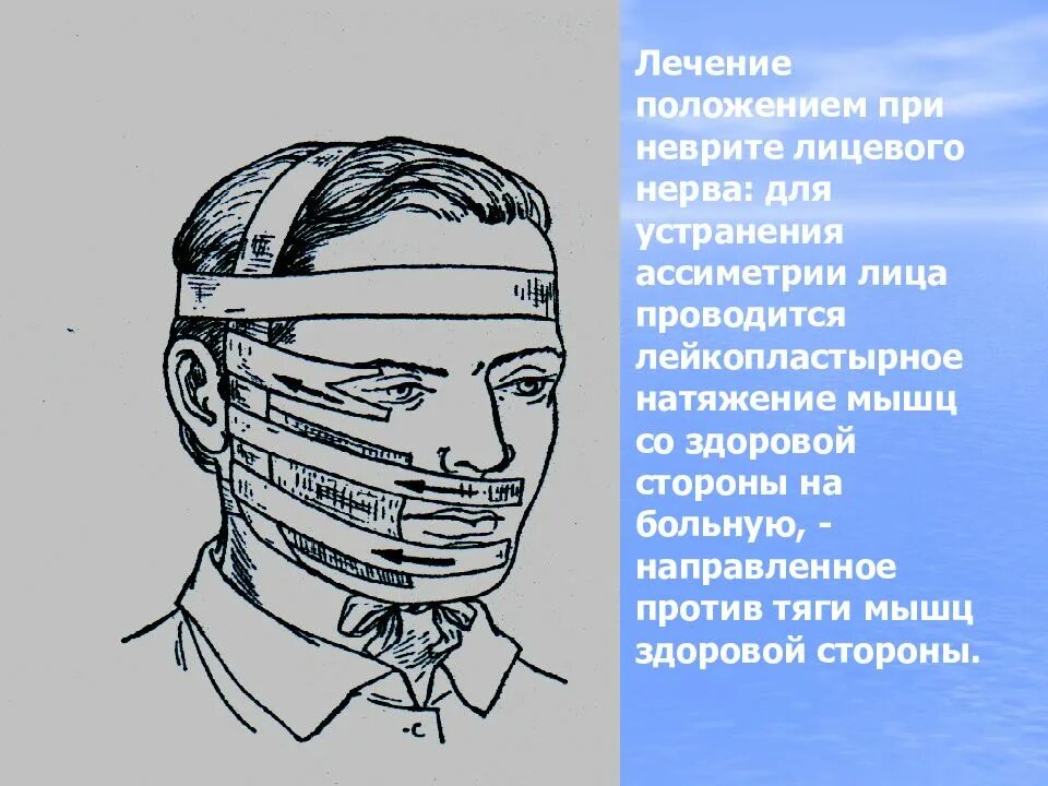 Иглоукалывание лицевой нерв. Неврит лицевого нерва лейкопластырное натяжение. Пластырное вытяжение при неврите лицевого нерва. Лейкопластырное вытяжение при неврите лицевого нерва. Лейкопластырного натяжения при неврите лицевого нерва?.