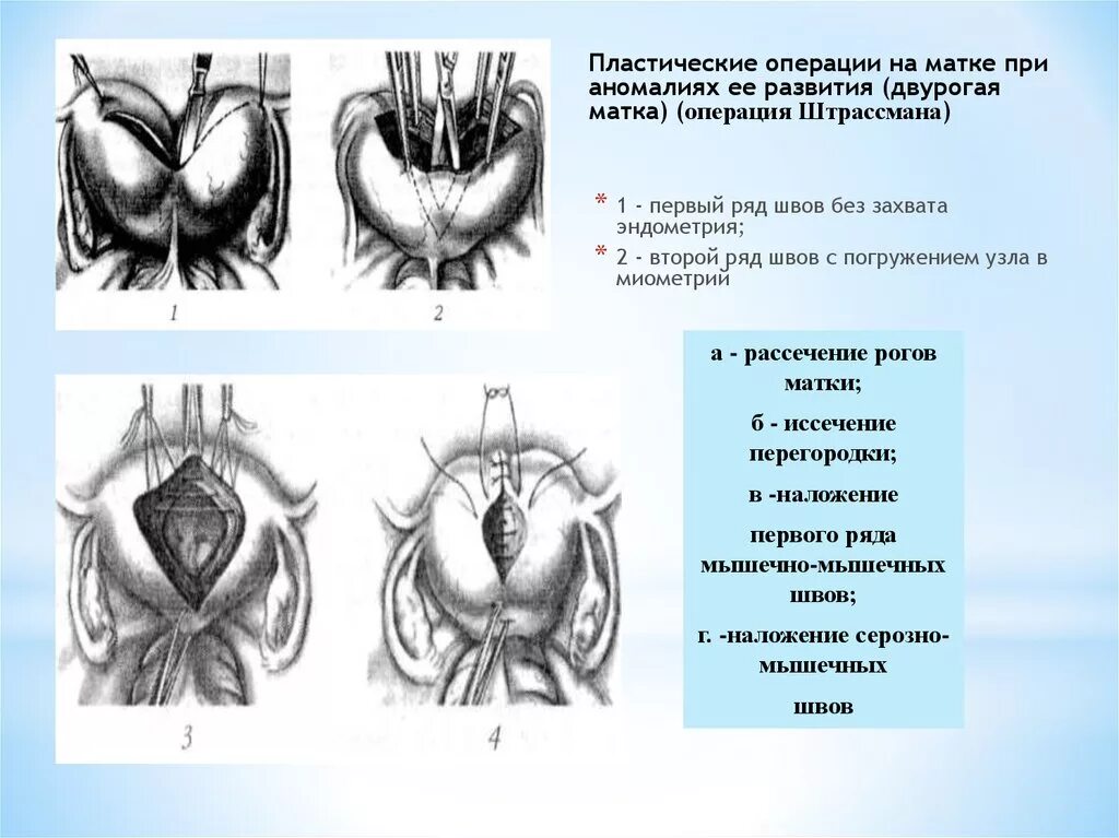 Операция пластика матки