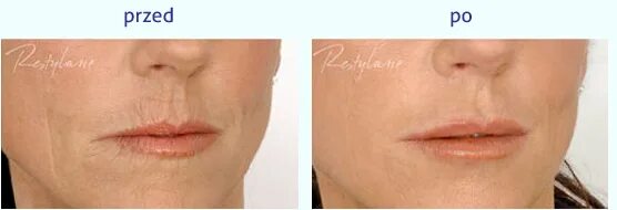 Морщины над верхней губой отзывы. Морщины над верхней губой отзывы. Коррекция кисетных морщин. Кисетные морщины после филлеров. Кисетные морщины ботокс.