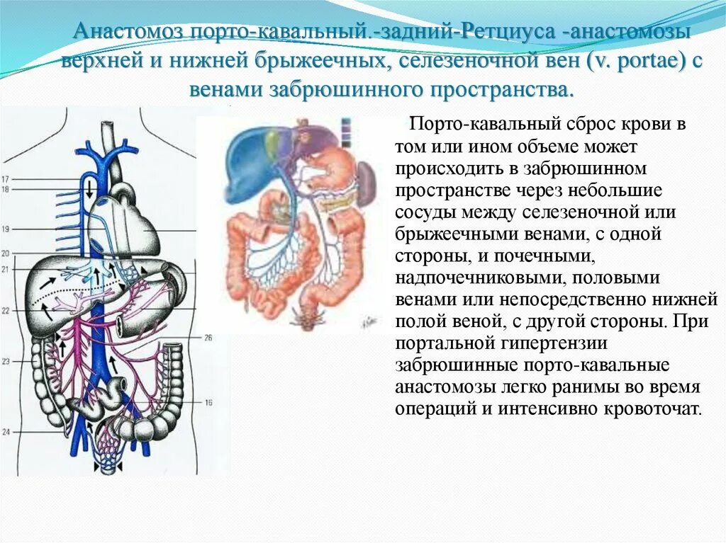 Значение кава кавальных анастомозов. Портокавальные анастомозы селезеночная вена. порто и кава кавальные анастомозы схема. воротная вена и портокавальные анастомозы. порто-кавальный анастомоз на узи.