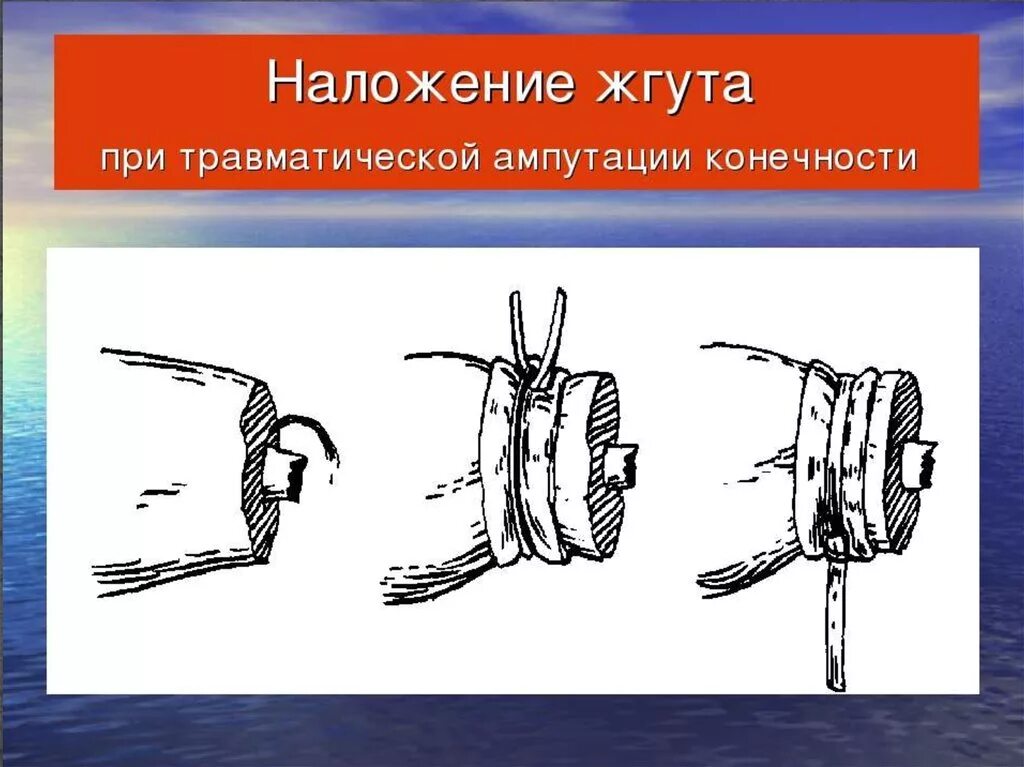 Оказание первой медицинской помощи при отрыве конечности. Оказание первой помощи при ампутации конечности. При травматической ампутации конечности. Оказание первой помощи при травматической ампутации.