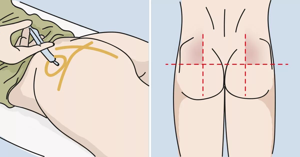 Как самому сделать внутримышечный укол в ягодицу