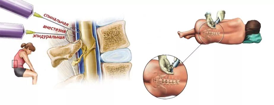 Эпидуралка болит спина. Спинномозговая и эпидуральная анестезия. Спинномозговая эпидуральная анестезия препараты. Эпидуральная анестезия шейного отдела позвоночника. Спинальная анестезия позвонок.