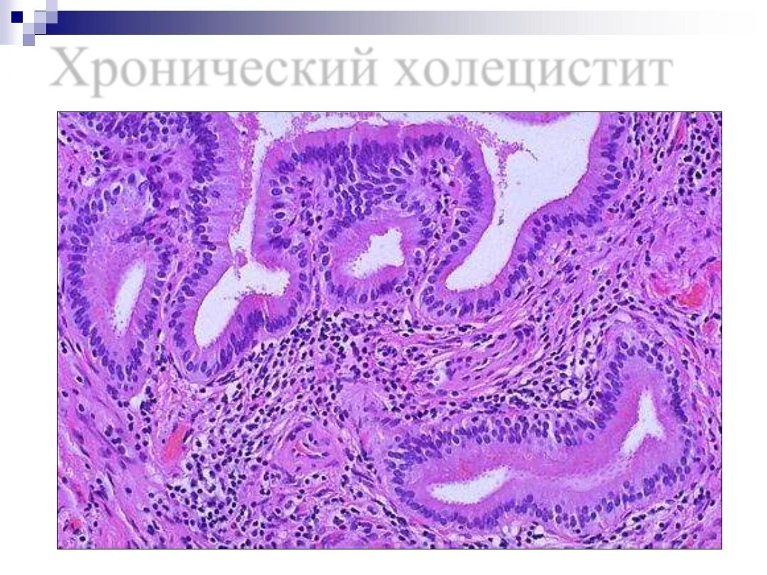 Аппендицит патанатомия. Острый холецистит патанатомия гистология. Флегмонозный холецистит гистология. Флегмонозно язвенный холецистит микропрепарат. Острый флегмонозный холецистит гистология.