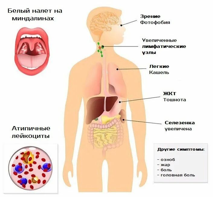 Как лечить мононуклеоз у детей. Инфекционный мононуклеоз у детей. инфекционный мононуклеоз симптомы. инфекционный мононуклеоз налет. симптомы инфекционного мононуклеоза симптомы.