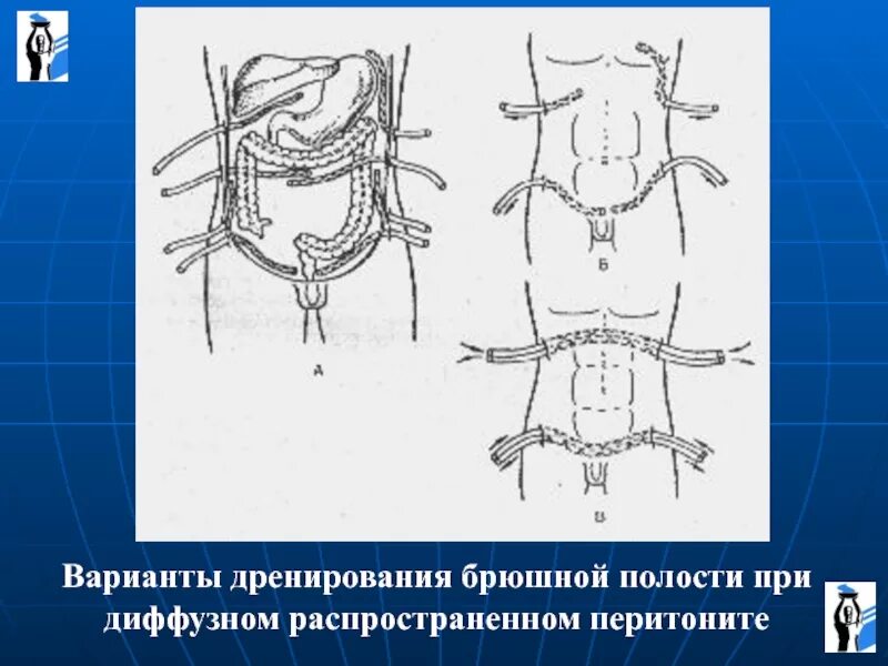 Дренирование полости абсцесса. Абсцесс брюшной полости операция. Перитонит лапаротомия. Операция по поводу перитонита