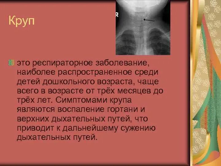 Что такое круп у детей. Круп заболевание у детей.