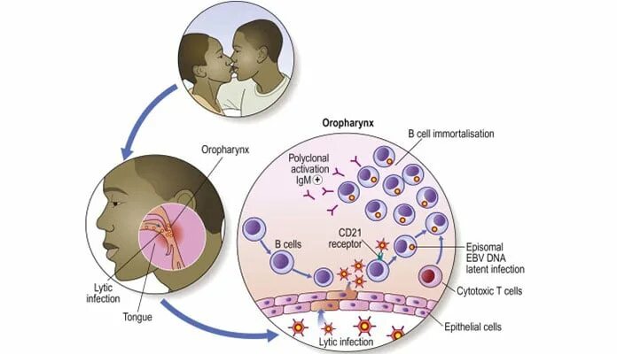 Герпес эпштейн барра у детей. Герпес 8 типа патогенез.