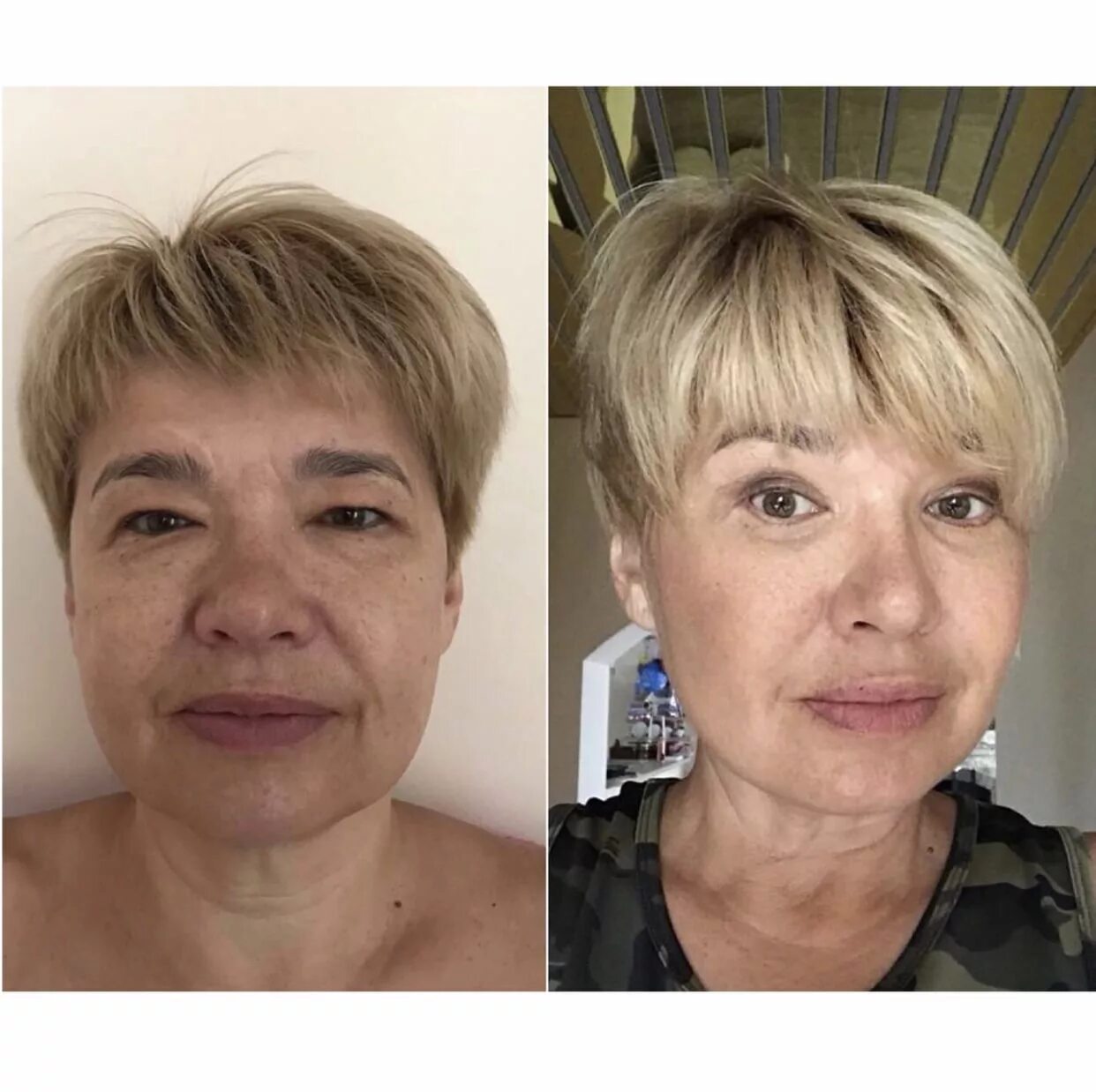 Блефаропластика и круговая подтяжки лица. Эндоскопическая подтяжка лица. Круговая пластика век тольятти. Рауф гайнуллин блефаропластика. Пластика лица екатеринбург.