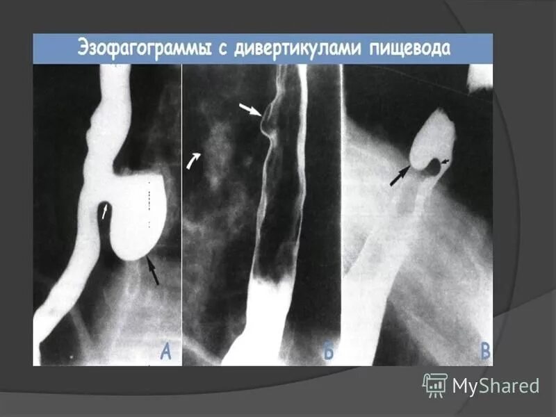 Дивертикул пищевода Ценкера рентген. Пульсионный дивертикул пищевода рентген. Бифуркационный дивертикул рентген. Тракционный дивертикул пищевода рентген. Дивертикул осложнения