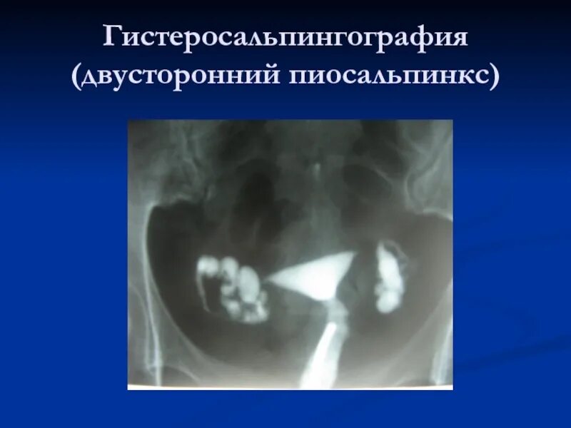 Pyosalpinx латынь