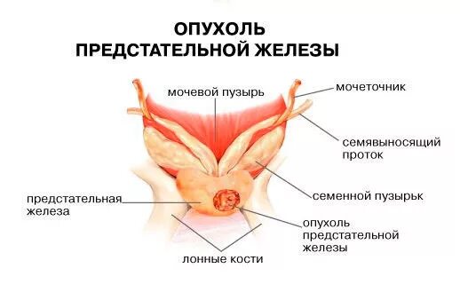 Простата рак симптомы лечение. Новообразование предстательной железы. Опухание предстательной железы. Отек предстательной железы. Опухоль предстательной железы у мужчин.