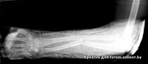 Старый перелом рентген