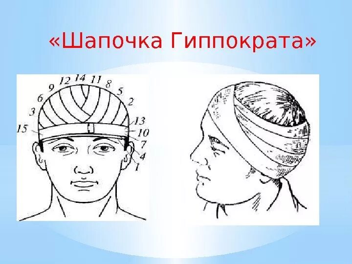Повязка гиппократа техника наложения. Десмургия шапочка Гиппократа. Чепец Гиппократа повязка. Повязка чепец и шапочка Гиппократа.