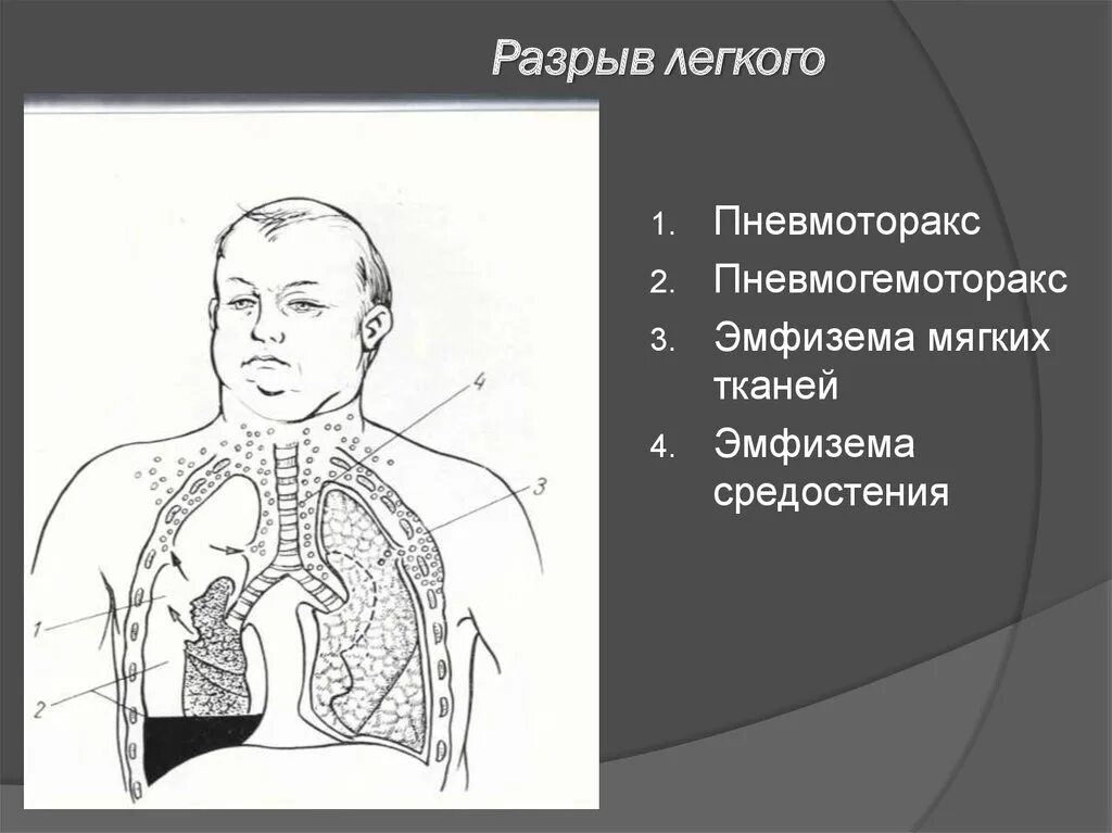 Повреждение легкого ребрами