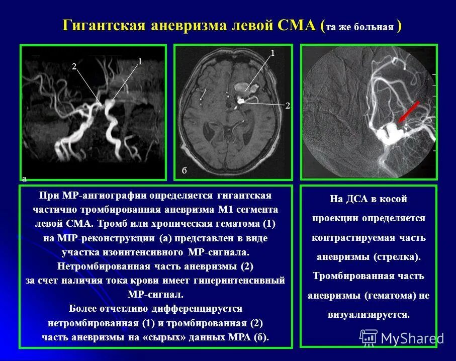 Аневризма головного мозга на кт. Сосудистые мальформации кт мрт. аневризма средней мозговой артерии кт. мрт мальформация средней мозговой артерии. средняя мозговая артерия м2 аневризма.