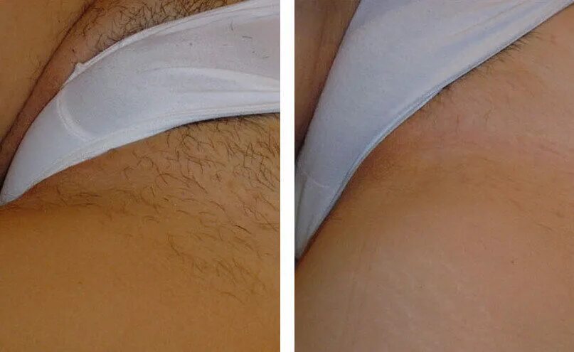 фотоэпиляция глубокое бикини. эпиляция бикини глубокое. шугаринг глубокое бикини. эпиляция глубоко во бикини. эпиляция глубокого бикини женщин.