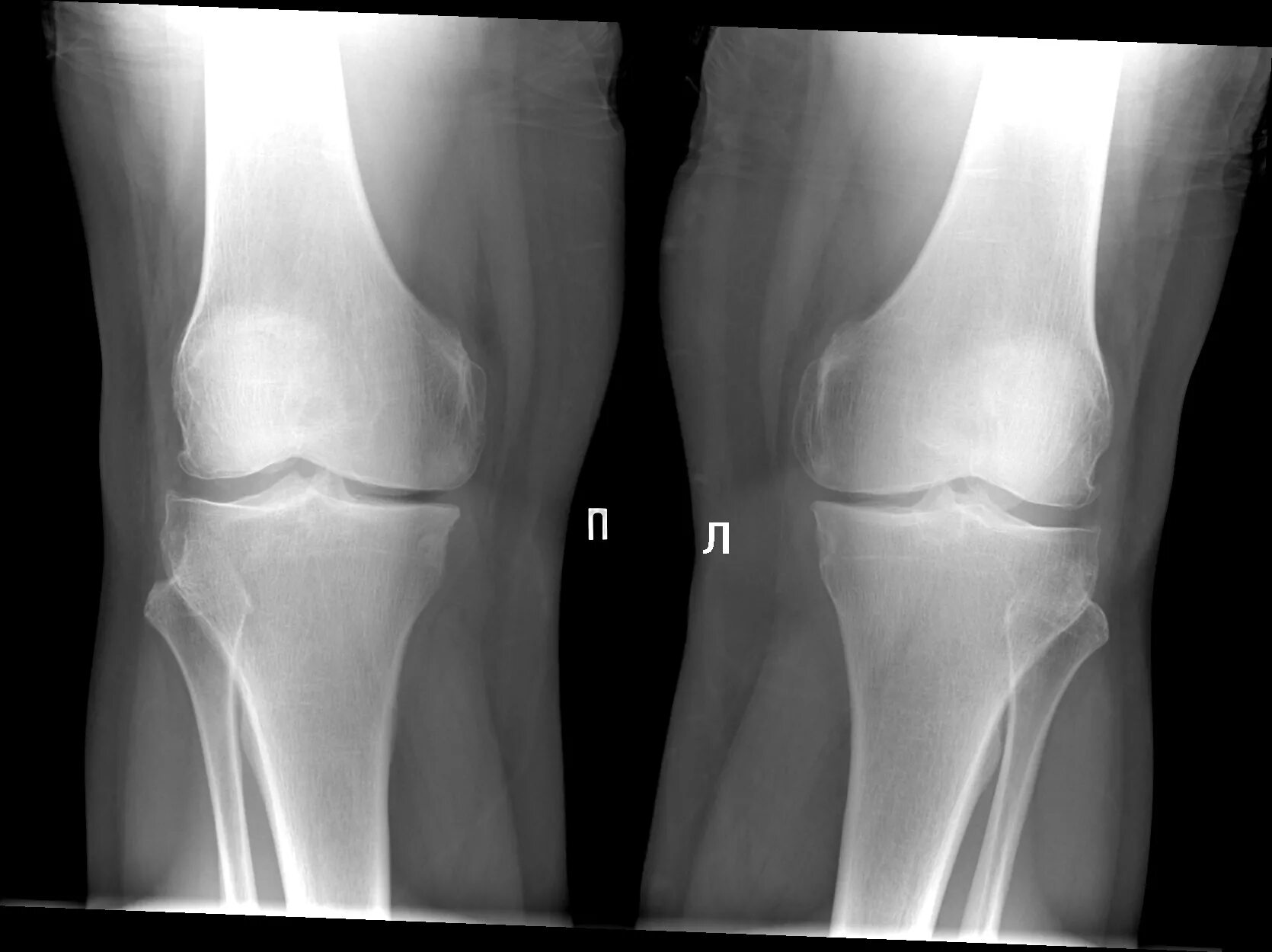 Два мыщелка. Остеосклероз медиального мыщелка. Хондрокальциноз коленного сустава рентген. Субхондральный остеосклероз медиального мыщелка. Мыщелки коленного сустава на рентгене.
